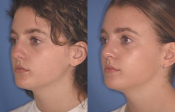 15 YR - 2 Months Postop: Rhinoplasty