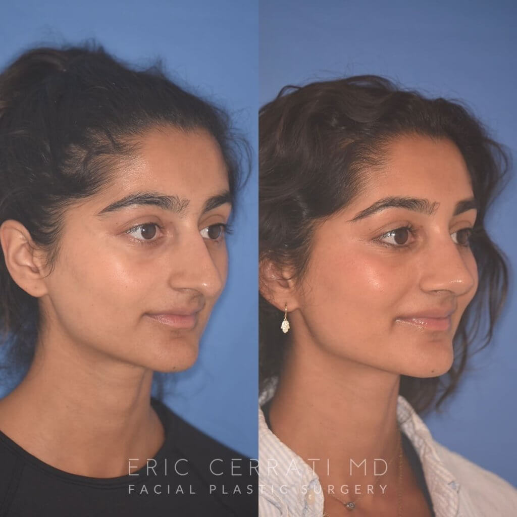 23 YR - 2 Months Postop: Rhinoplasty