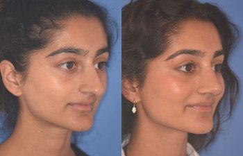 23 YR - 2 Months Postop: Rhinoplasty