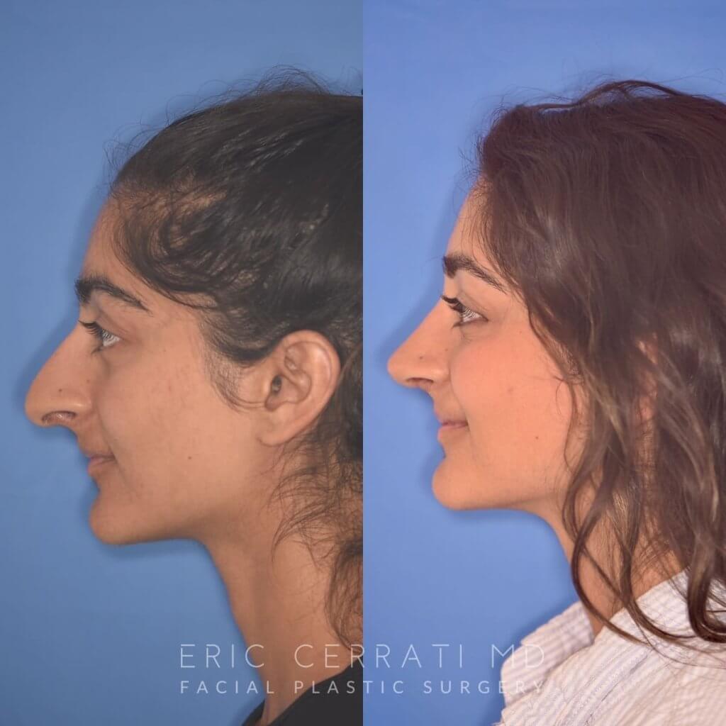 23 YR - 2 Months Postop: Rhinoplasty