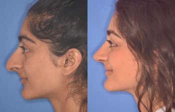 23 YR - 2 Months Postop: Rhinoplasty