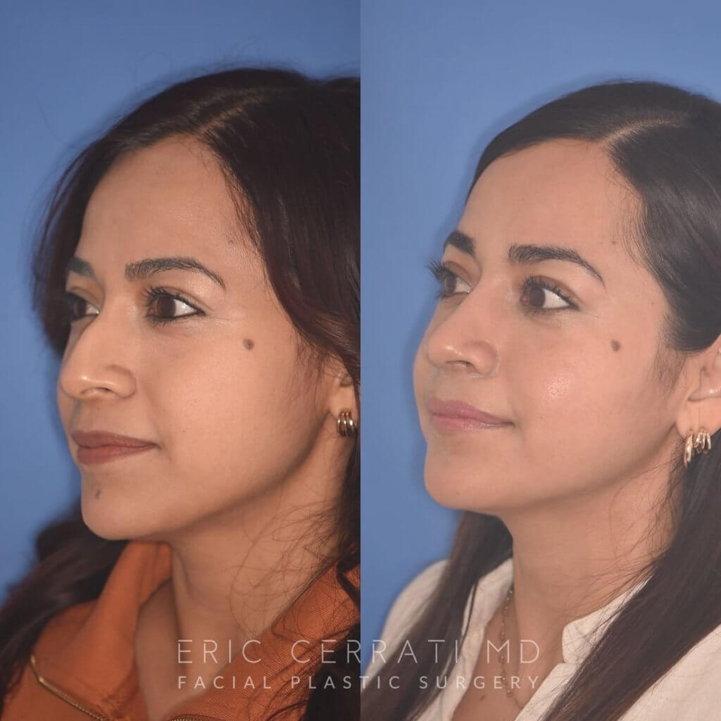 35 YR - 2 Months Postop: Rhinoplasty