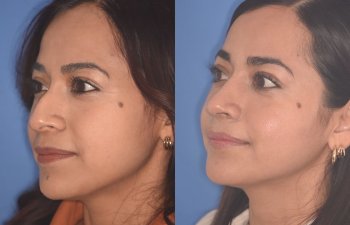 35 YR - 2 Months Postop: Rhinoplasty