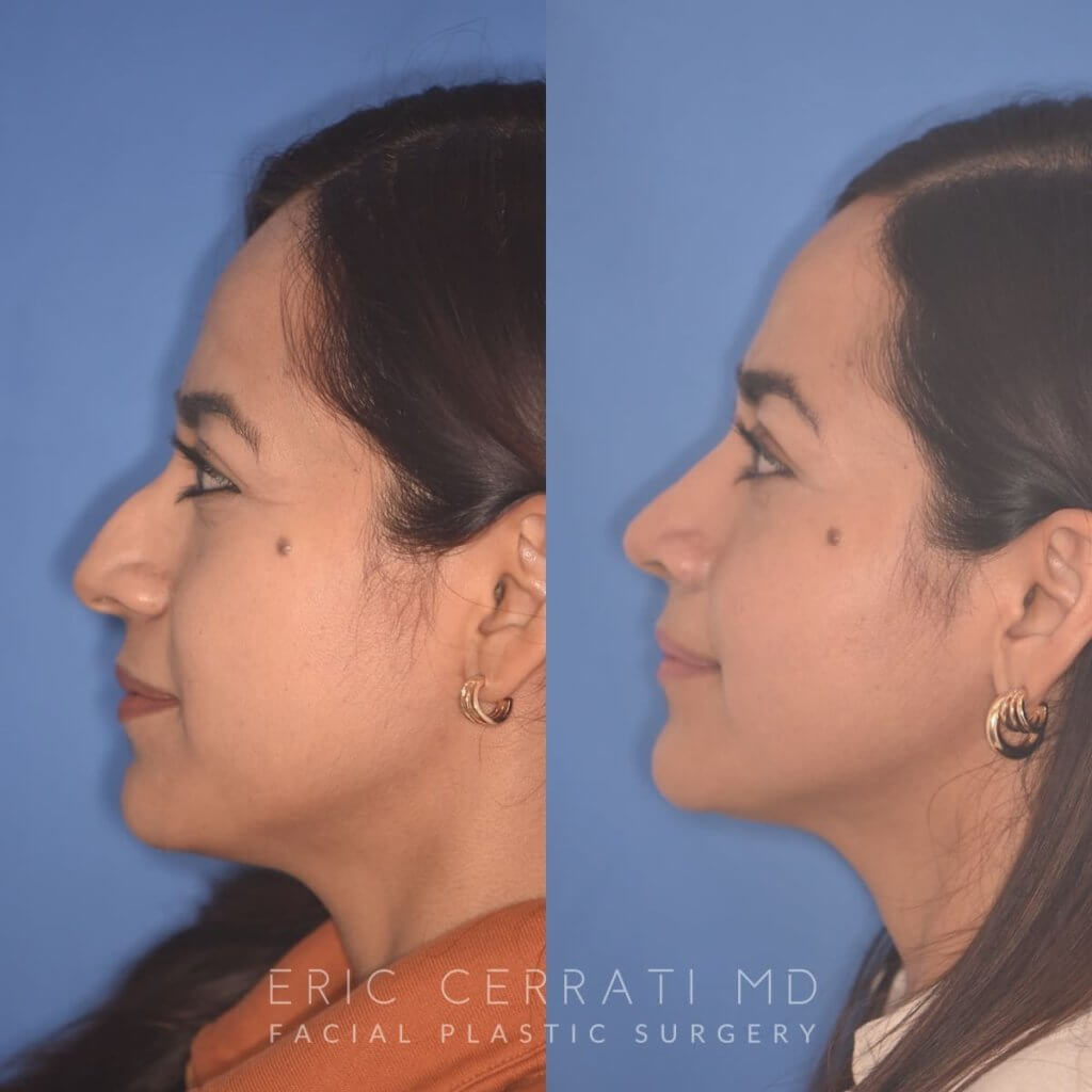 35 YR - 2 Months Postop: Rhinoplasty