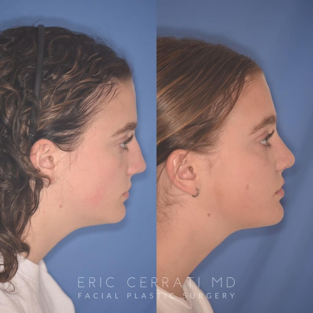 15 YR - 2 Months Postop: Rhinoplasty