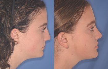 15 YR - 2 Months Postop: Rhinoplasty