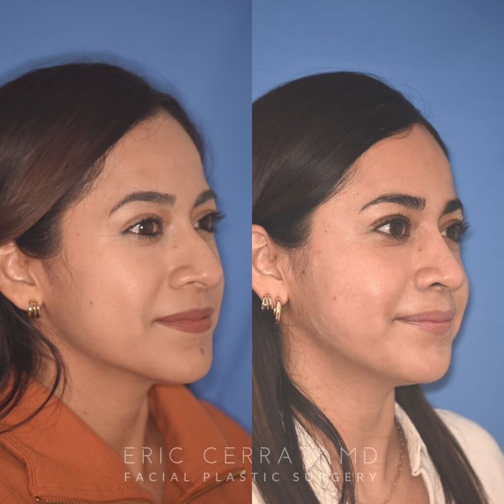 35 YR - 2 Months Postop: Rhinoplasty