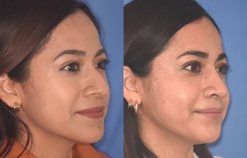 35 YR - 2 Months Postop: Rhinoplasty