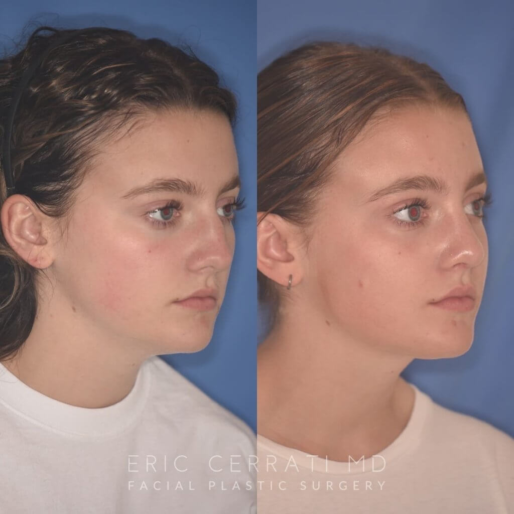 15 YR - 2 Months Postop: Rhinoplasty