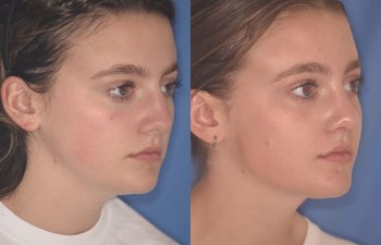 15 YR - 2 Months Postop: Rhinoplasty