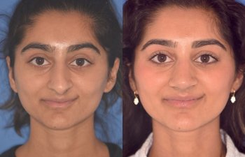 23 YR - 2 Months Postop: Rhinoplasty