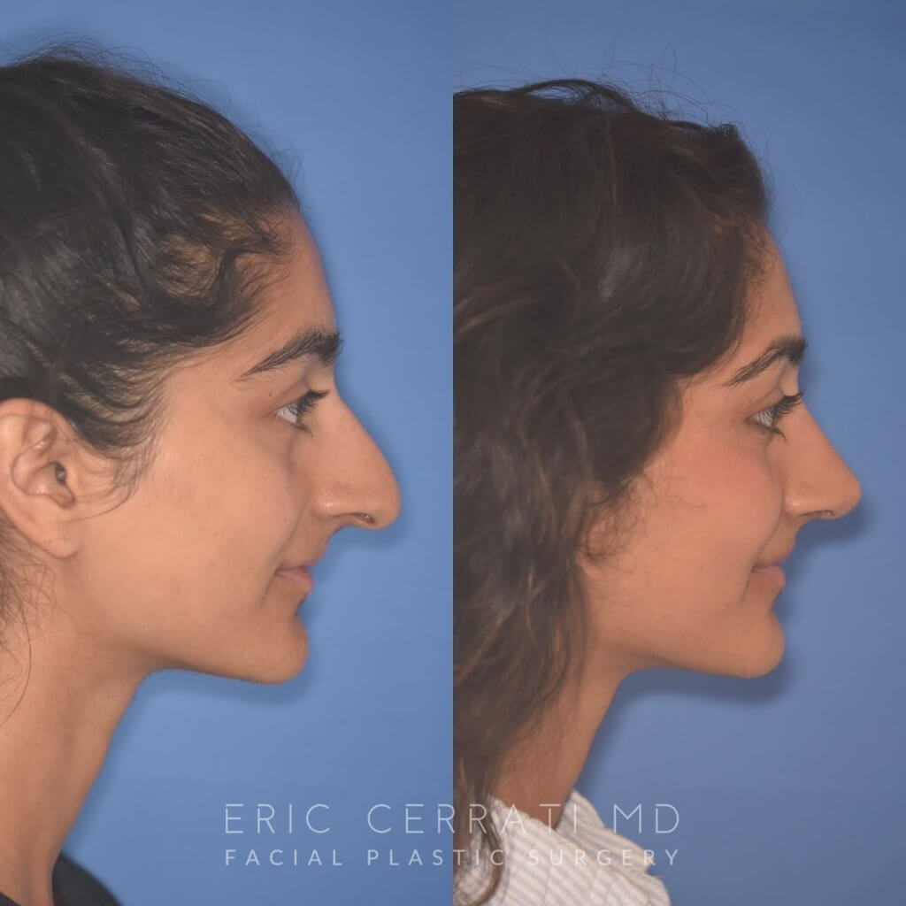 23 YR - 2 Months Postop: Rhinoplasty