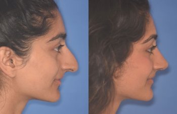 23 YR - 2 Months Postop: Rhinoplasty
