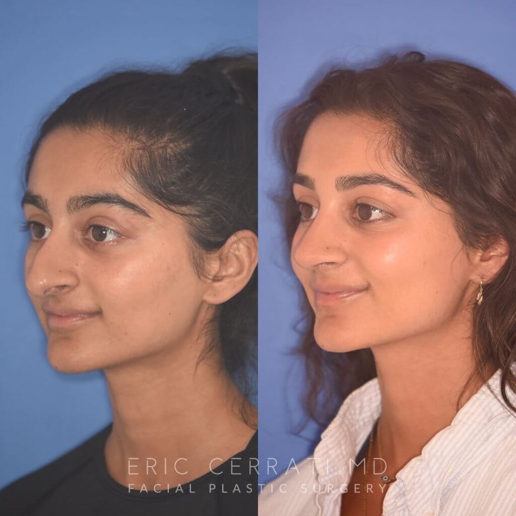 23 YR - 2 Months Postop: Rhinoplasty