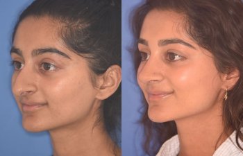 23 YR - 2 Months Postop: Rhinoplasty