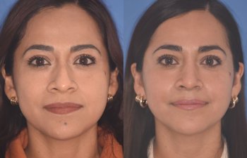 35 YR - 2 Months Postop: Rhinoplasty