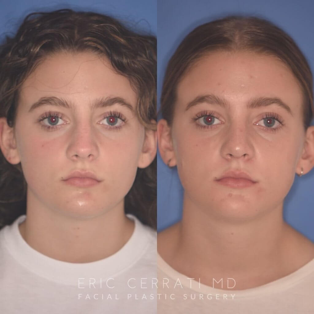 15 YR - 2 Months Postop: Rhinoplasty