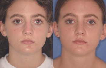 15 YR - 2 Months Postop: Rhinoplasty