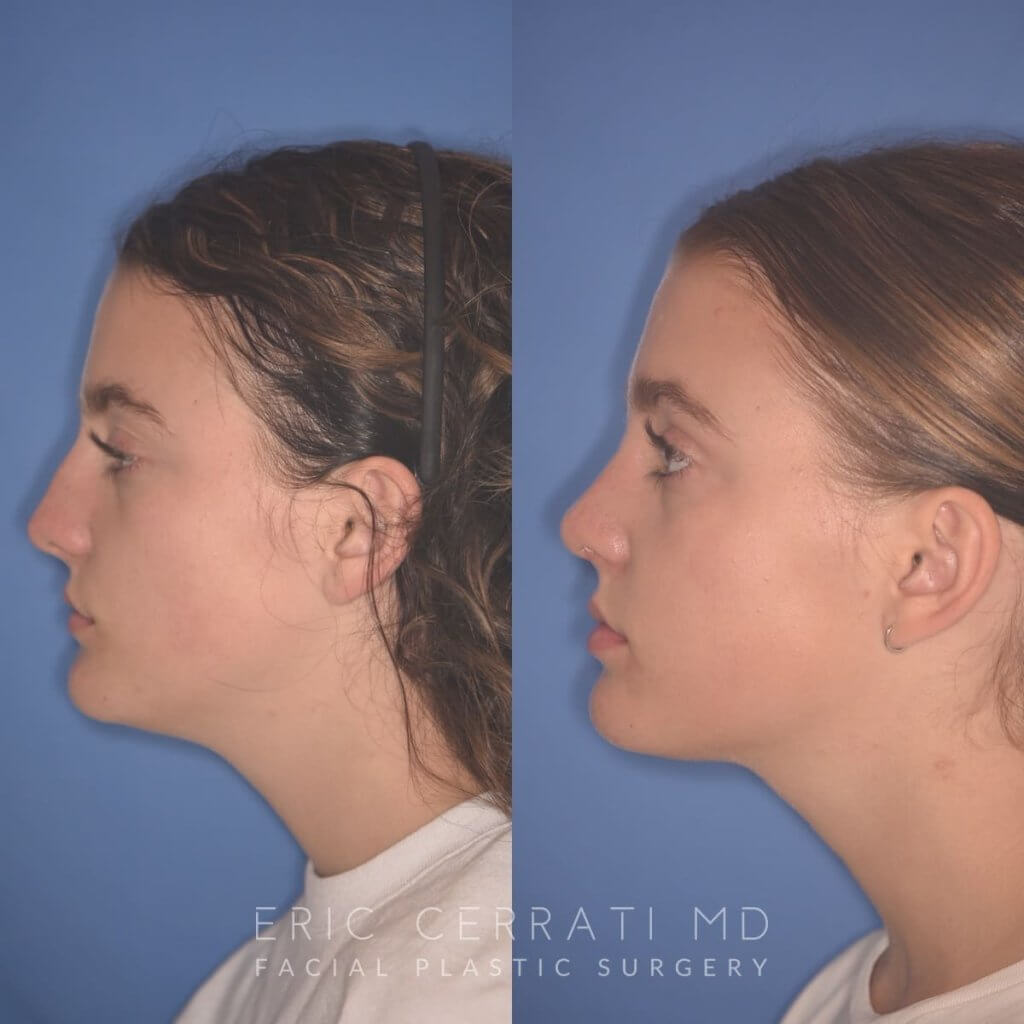 15 YR - 2 Months Postop: Rhinoplasty