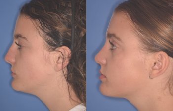 15 YR - 2 Months Postop: Rhinoplasty