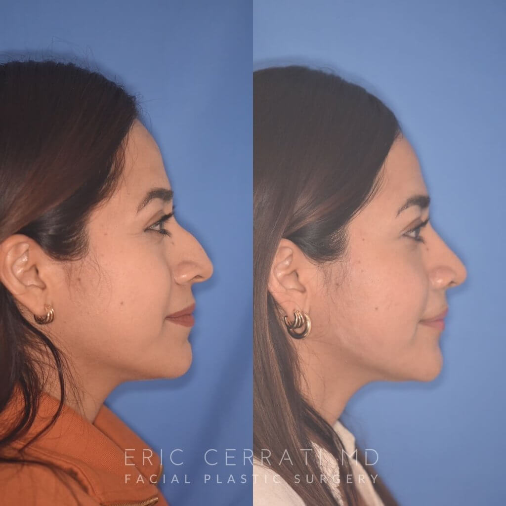 35 YR - 2 Months Postop: Rhinoplasty