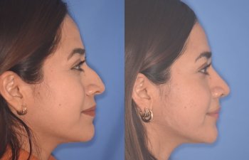 35 YR - 2 Months Postop: Rhinoplasty