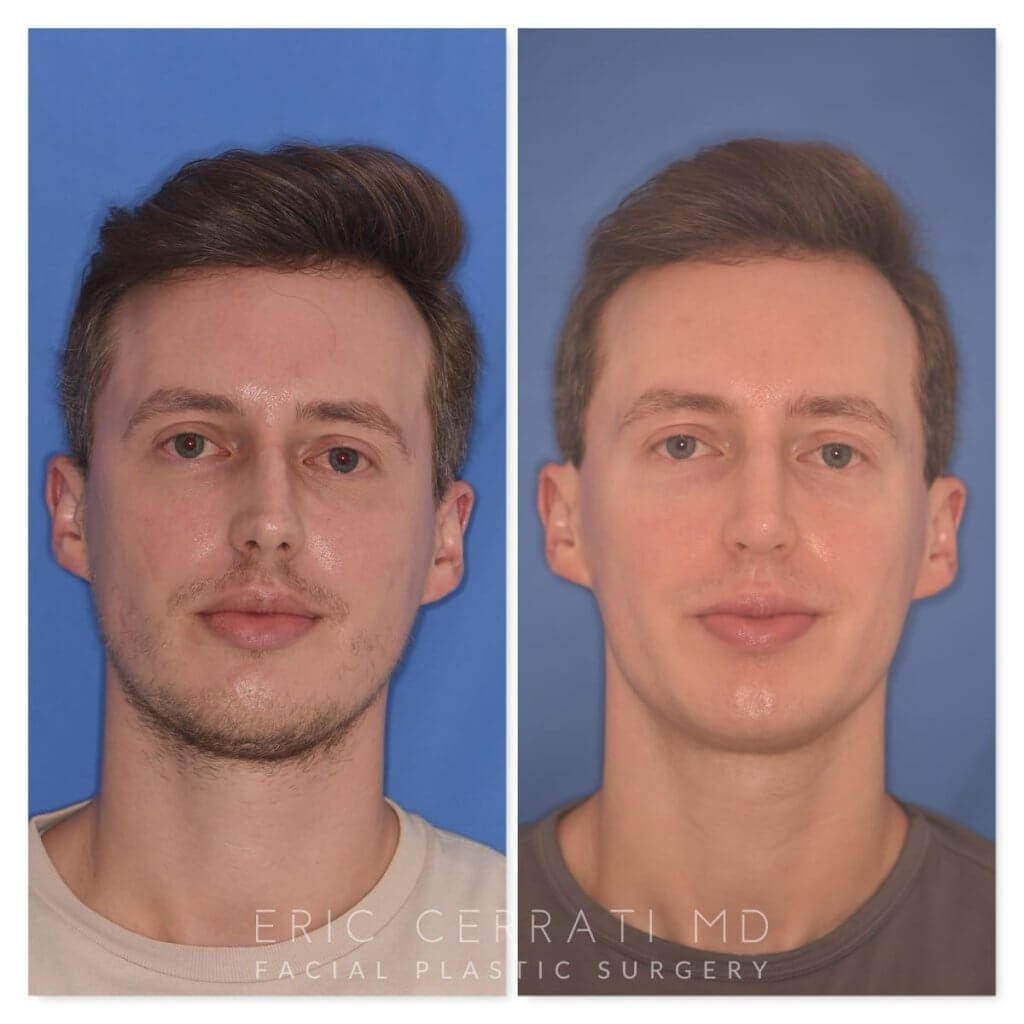 32 YR - 6 Months Postop: Rhinoplasty