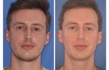 32 YR - 6 Months Postop: Rhinoplasty
