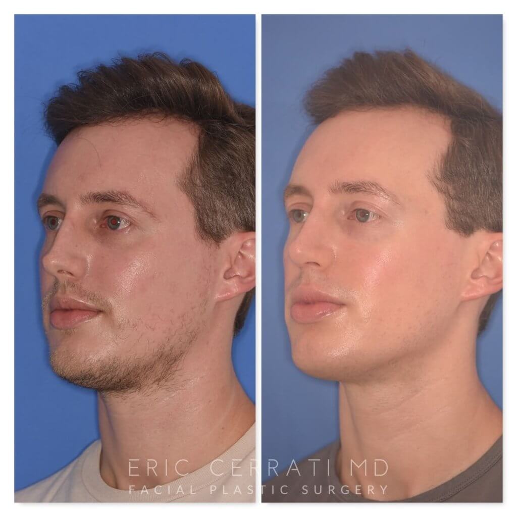 32 YR - 6 Months Postop: Rhinoplasty