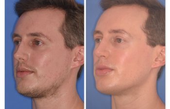 32 YR - 6 Months Postop: Rhinoplasty