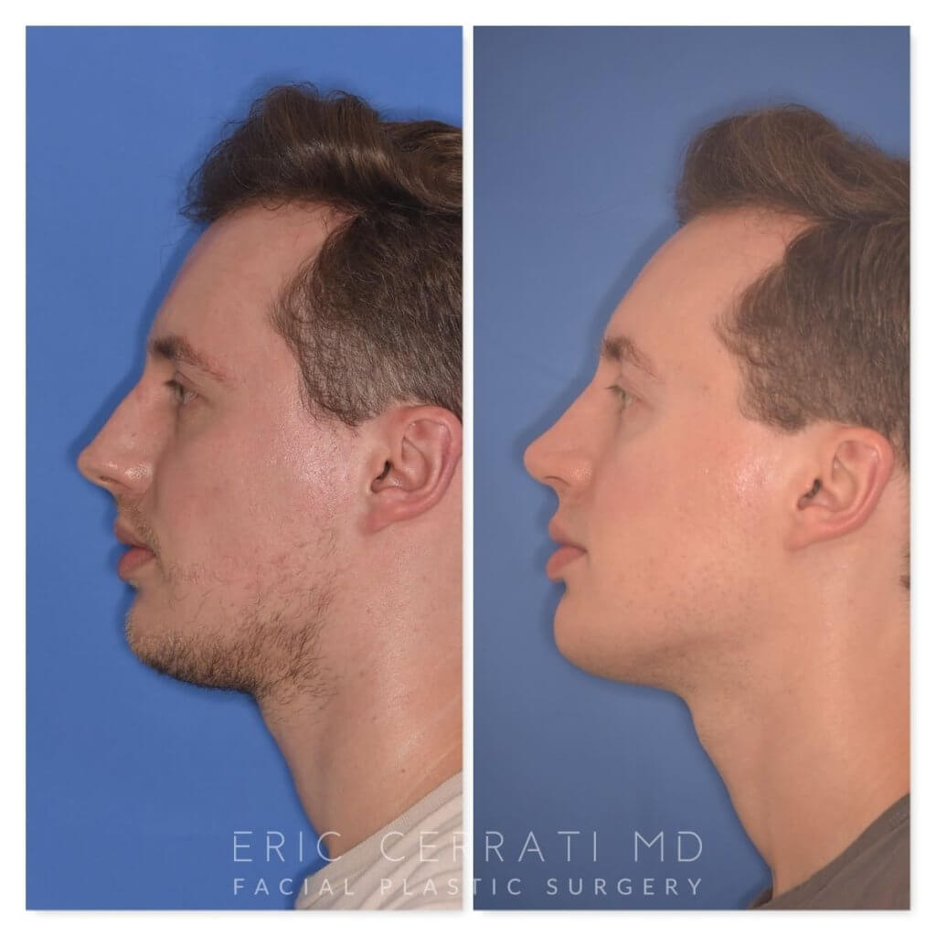 32 YR - 6 Months Postop: Rhinoplasty