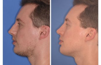 32 YR - 6 Months Postop: Rhinoplasty