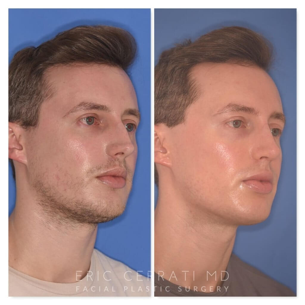 32 YR - 6 Months Postop: Rhinoplasty