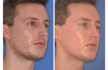 32 YR - 6 Months Postop: Rhinoplasty