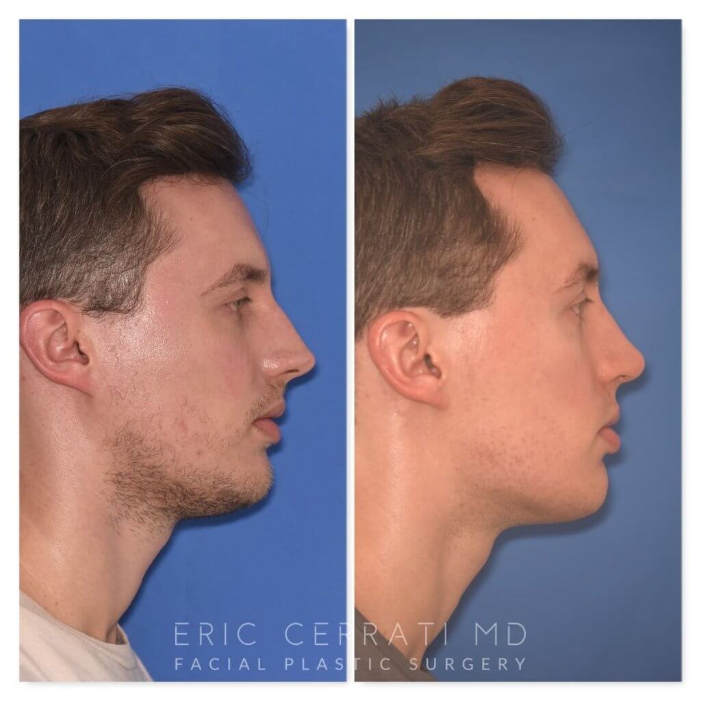 32 YR - 6 Months Postop: Rhinoplasty