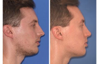 32 YR - 6 Months Postop: Rhinoplasty