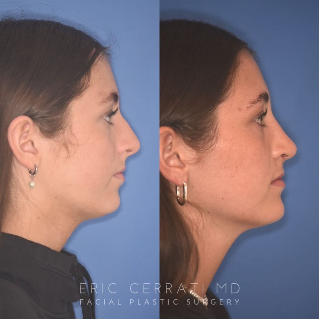 15 YR - 2 Months Postop: Rhinoplasty