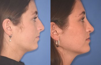 15 YR - 2 Months Postop: Rhinoplasty