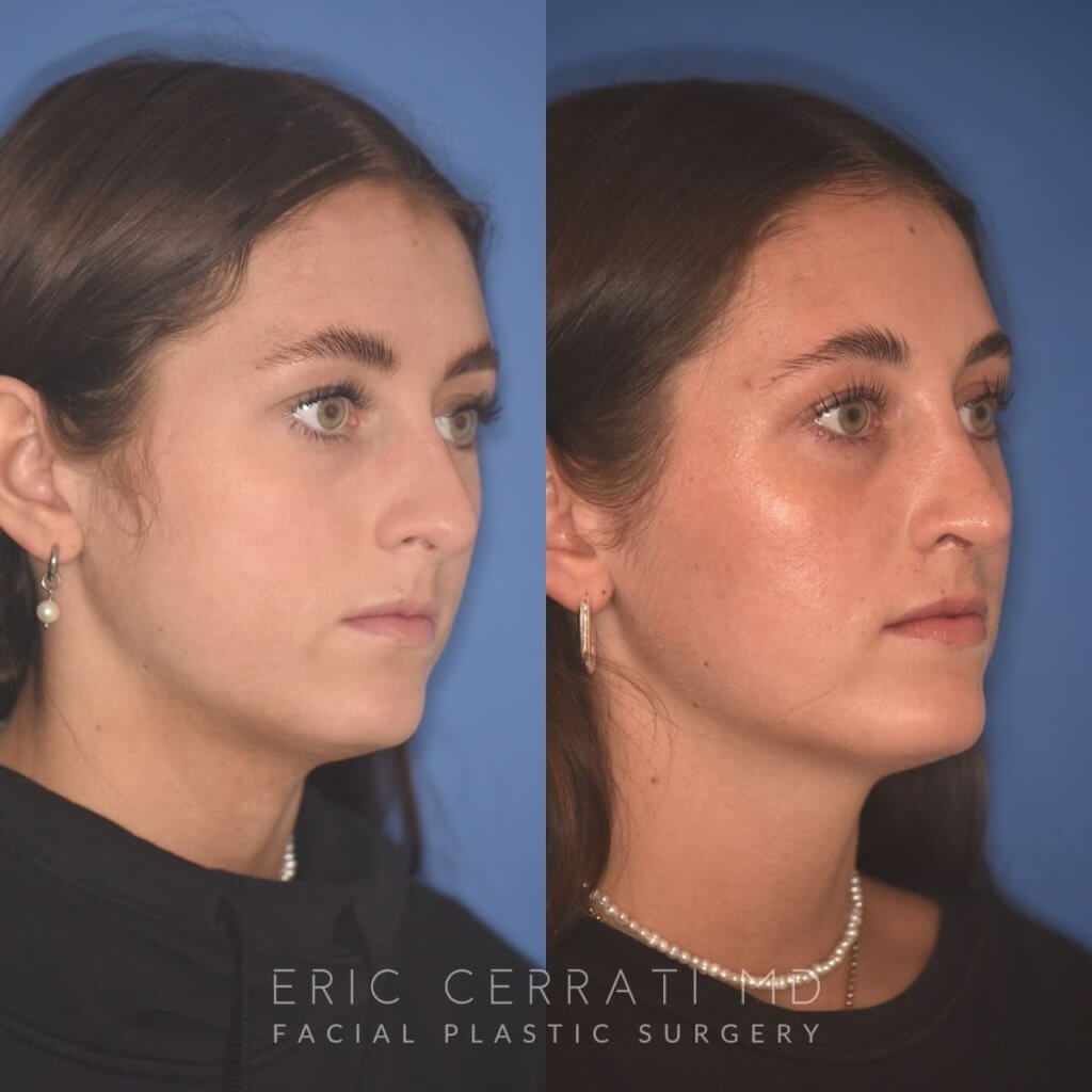15 YR - 2 Months Postop: Rhinoplasty