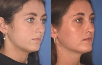 15 YR - 2 Months Postop: Rhinoplasty