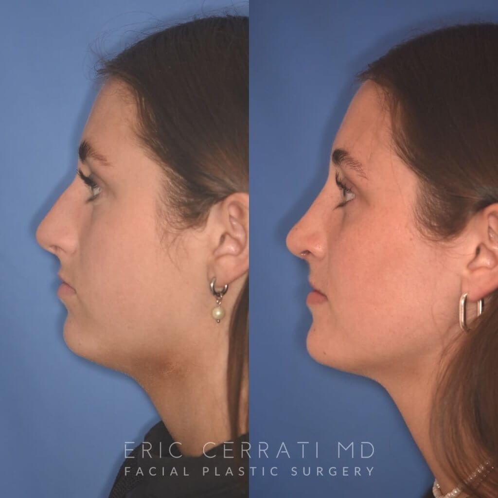 15 YR - 2 Months Postop: Rhinoplasty