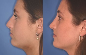 15 YR - 2 Months Postop: Rhinoplasty