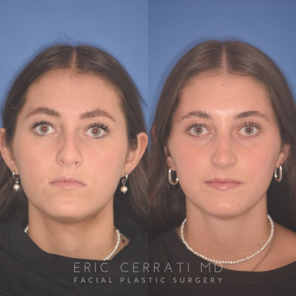15 YR - 2 Months Postop: Rhinoplasty