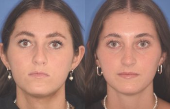 15 YR - 2 Months Postop: Rhinoplasty