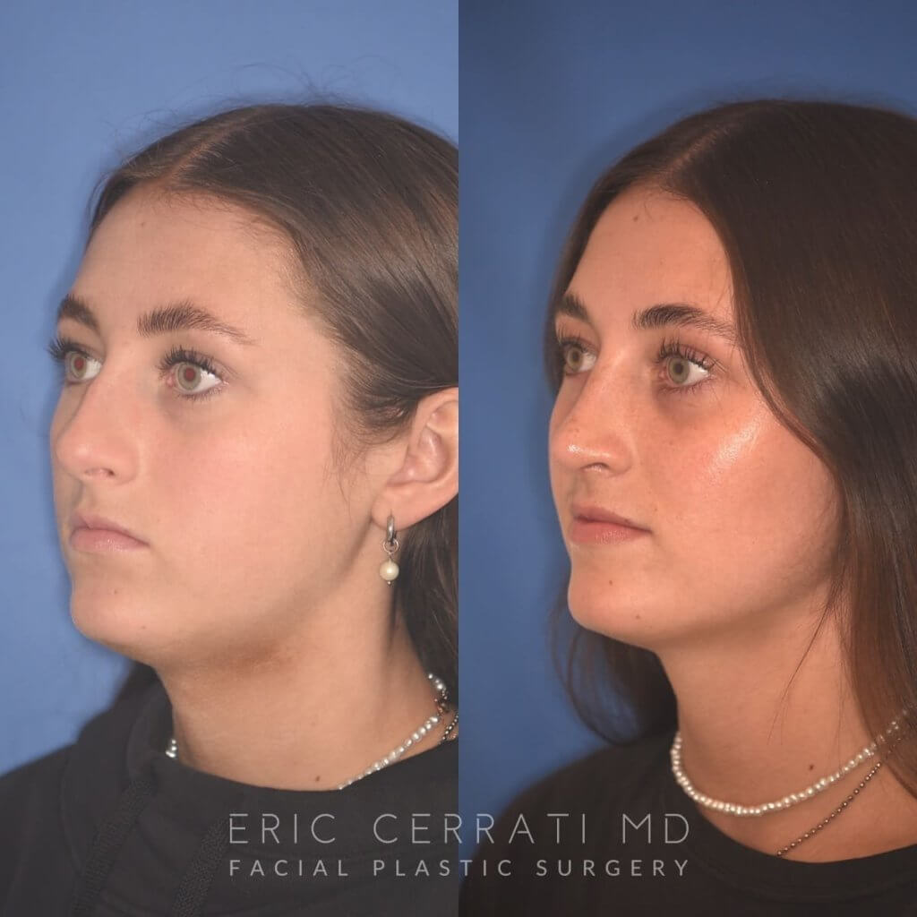15 YR - 2 Months Postop: Rhinoplasty