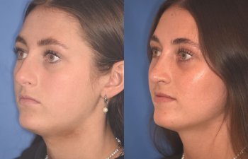 15 YR - 2 Months Postop: Rhinoplasty