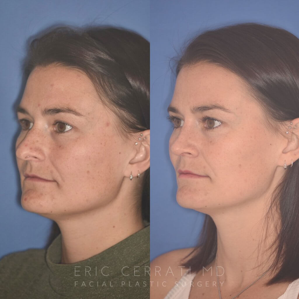 27 YR - 2 Months Postop: Rhinoplasty