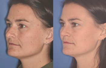 27 YR - 2 Months Postop: Rhinoplasty