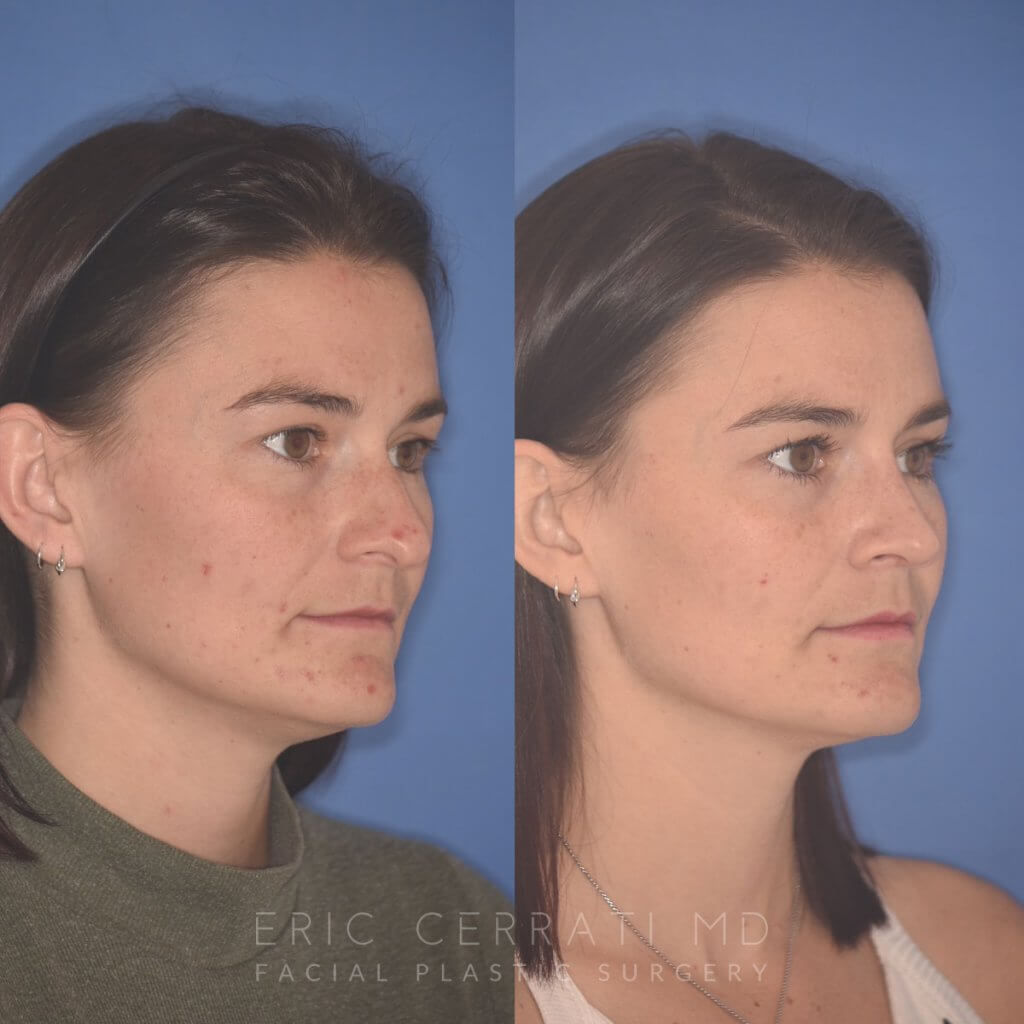 27 YR - 2 Months Postop: Rhinoplasty