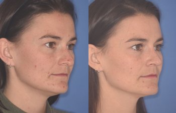 27 YR - 2 Months Postop: Rhinoplasty